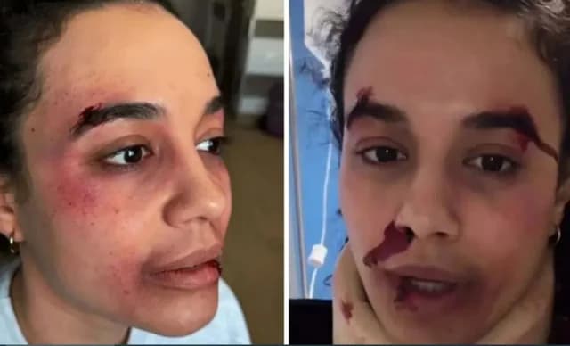 Penélope Plaka: Reacciones a las fotos con moretones