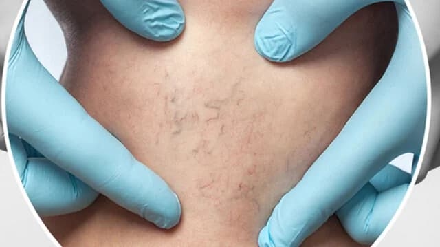 Escleroterapia: Una solución eficaz para las arañas vasculares