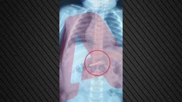 Three-year-old swallows razor, undergoes surgery at Children's Hospital