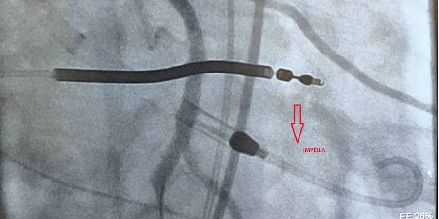 Erfolgreiche erste Impella-Implantation in Zypern durch das Ygeia Krankenhaus