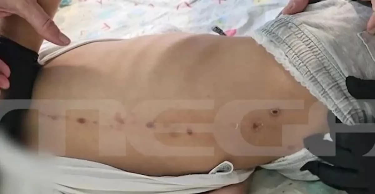 Patras: Investigación por abuso de un niño discapacitado de 7 años – Marcas en la espalda