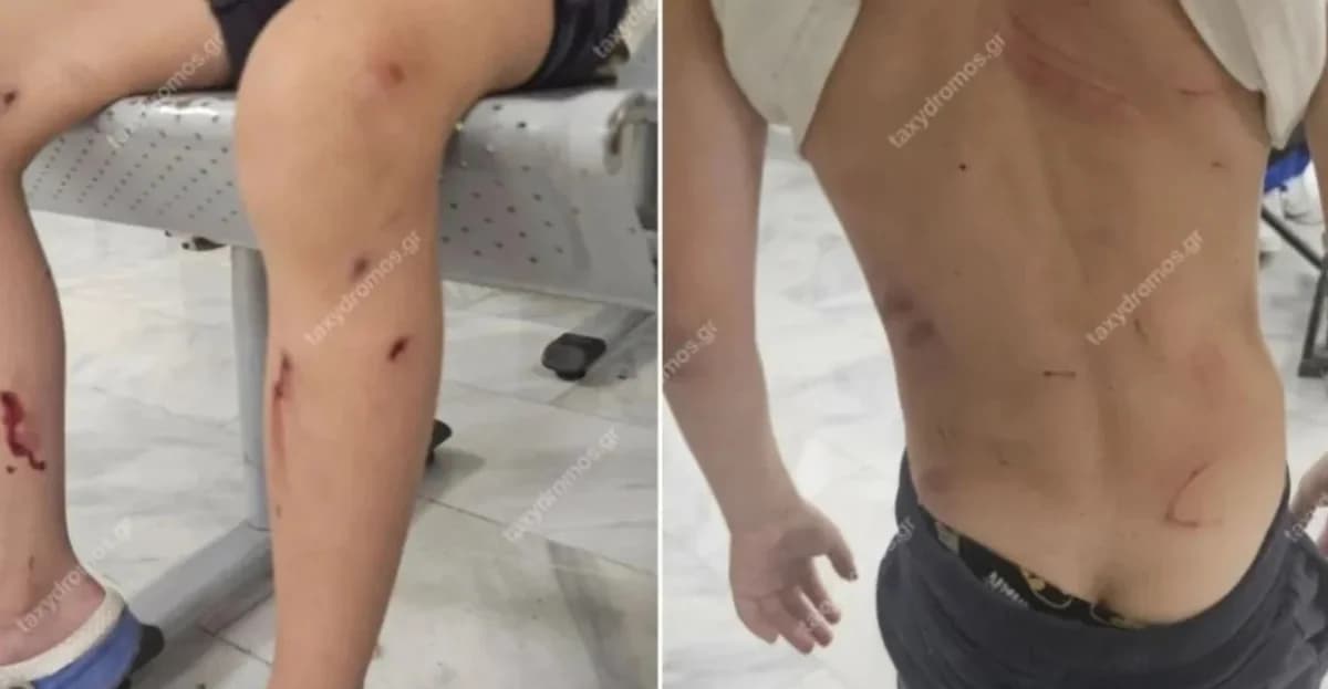 Βόλος: Επίθεση αδέσποτων σε 7χρονο – Στο νοσοκομείο