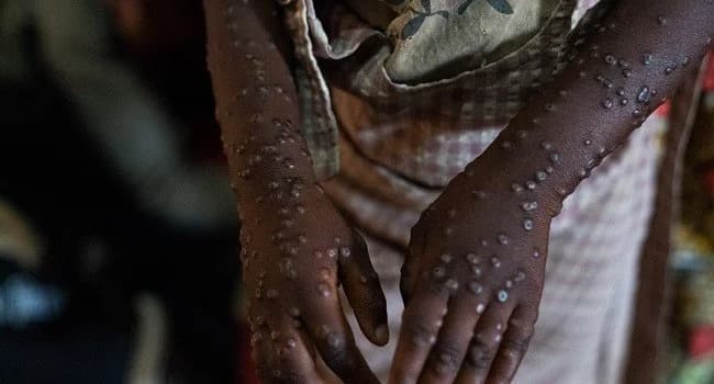 Ghana Records First Mpox Death Amid Rising Cases