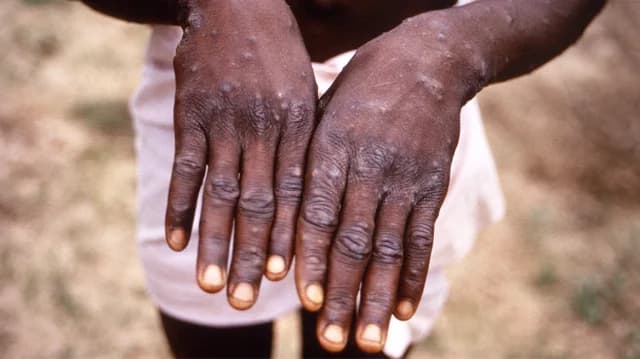 Ghana: First Death from Mpox Outbreak