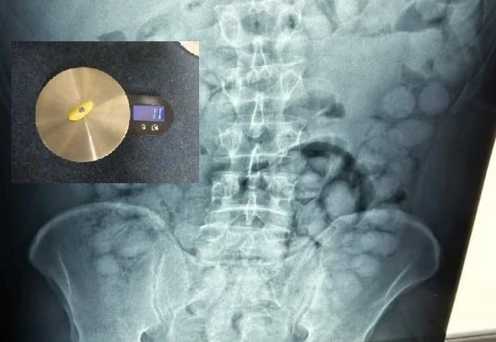 Arrestan a brasileño en el aeropuerto de Atenas con cápsulas de cocaína