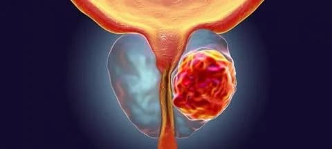 Hunderte neue Prostatakrebsdiagnosen jährlich in Zypern