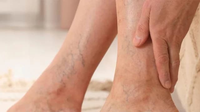 ¿Cuándo es necesaria la cirugía para las varices?