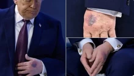 El hematoma en la mano de Trump provoca rumores: su respuesta