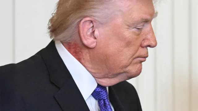Trumps Ausschlag wirft neue Gesundheitsfragen auf