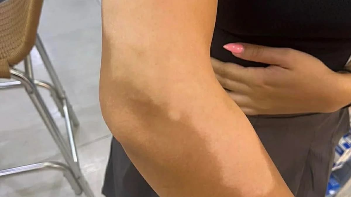 Cyprus: High Cost for Vitiligo Patients – €864 Cream